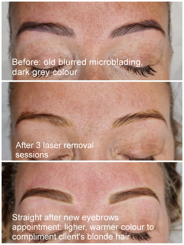 Before  After Laser Tattoo Removal Results  MEDermis